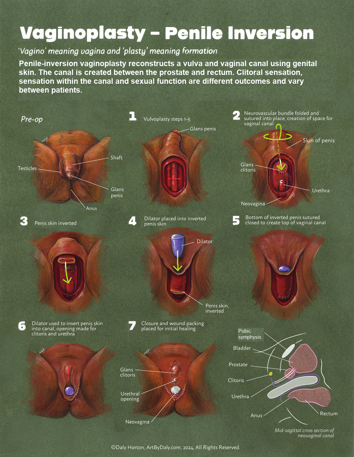 Illustrated penile-inversion vaginoplasty sequence with the canal lining and a side view of pelvic anatomy.