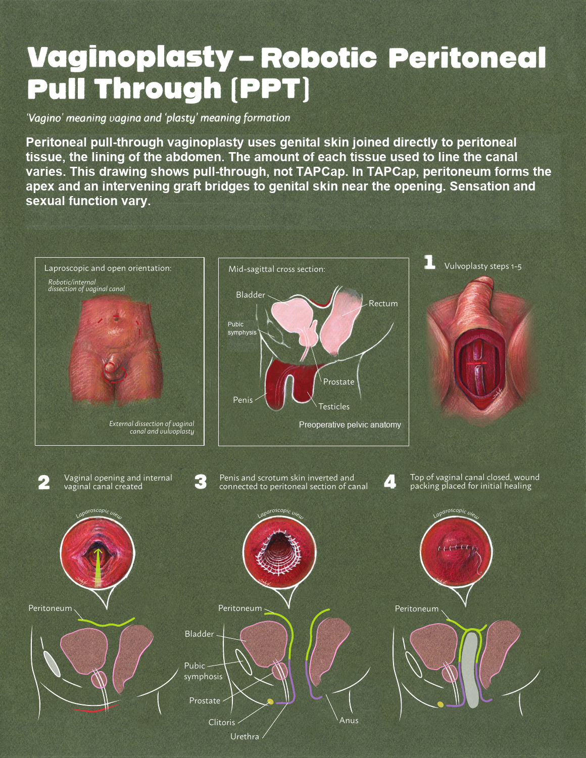 Illustrated peritoneal vaginoplasty with abdominal and external views and a side view of the canal.